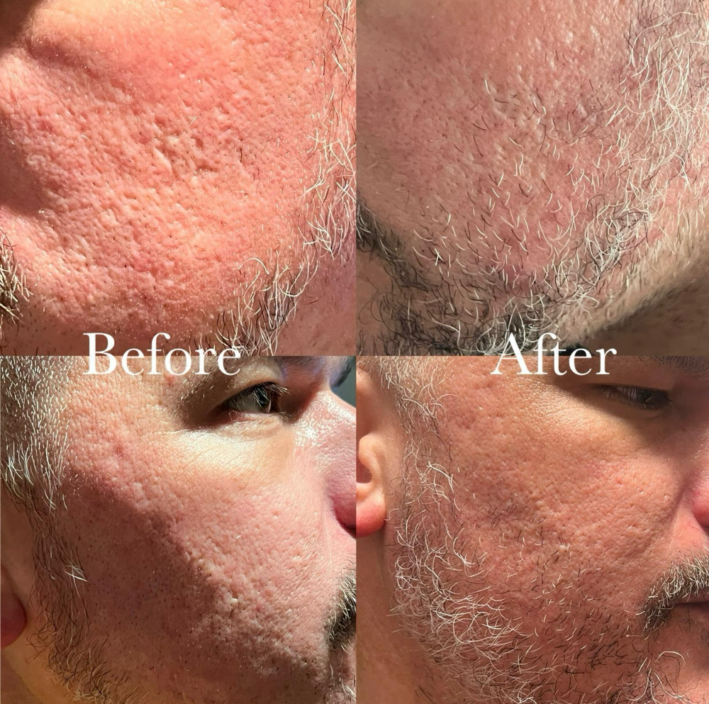 Acne Scar Revision (Inkless)