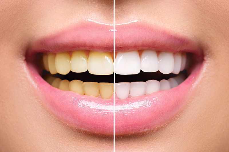 Teeth Whitening (1 Session) at B’Luxury Beauty & Body Studios in Doraville, GA