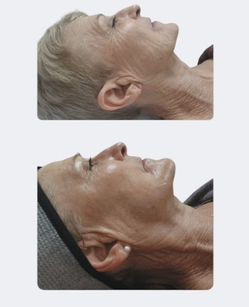ARMA-LIFT BioFacial at AV Esthetique in Highland Park, IL