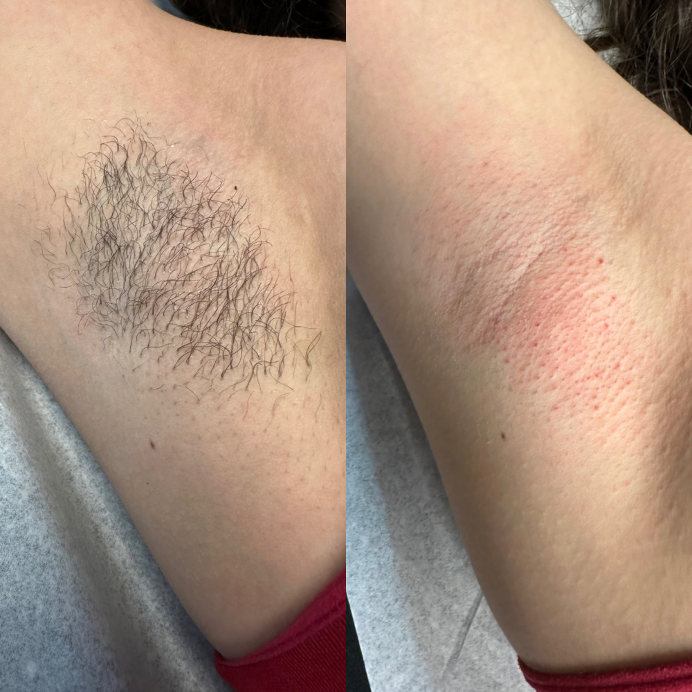 Wax Underarm