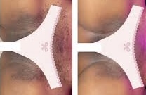 Intimate Bleaching