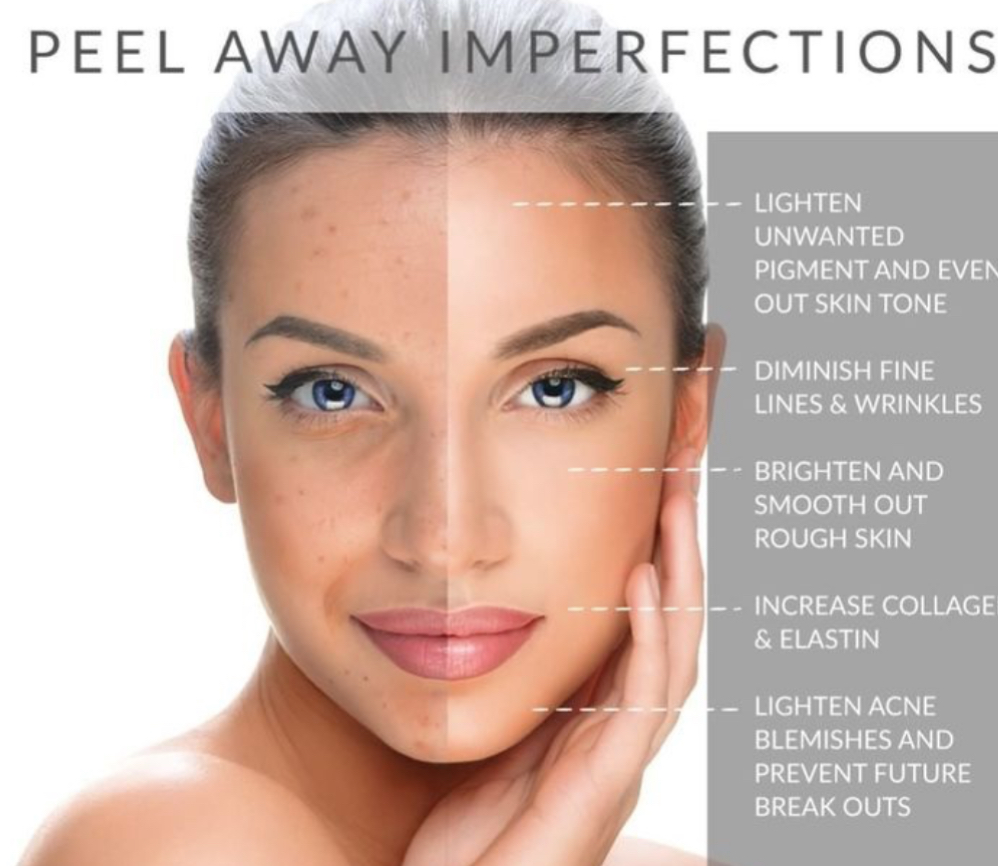 SKT: Peel (Chemical Peel)