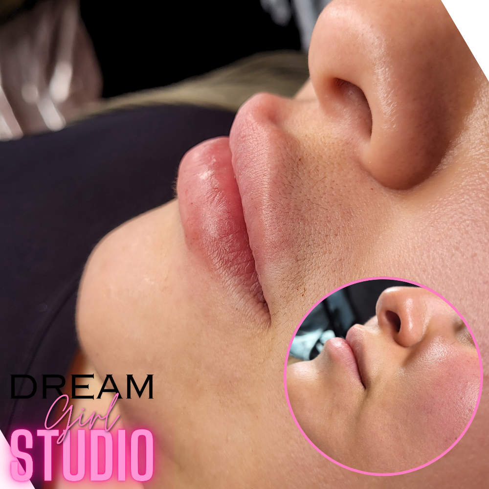 2ML Lip Filler
