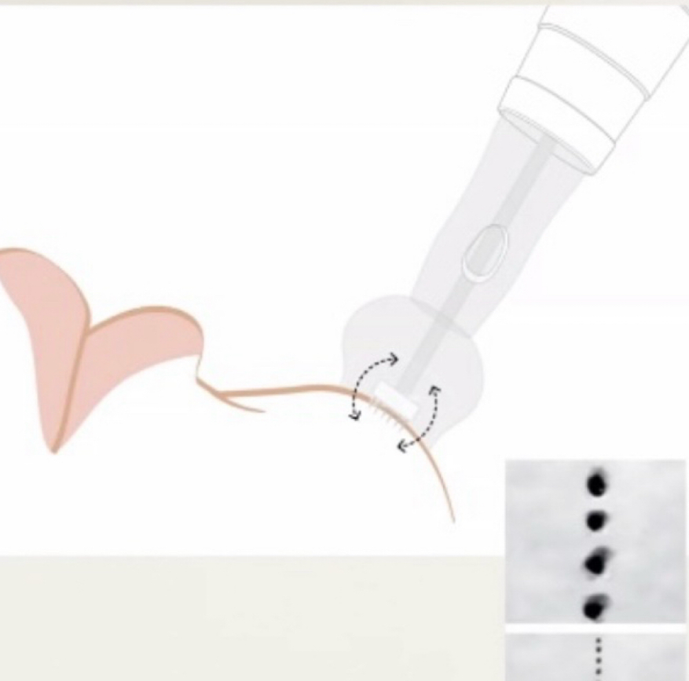 MicroNeedling - at Skin Ritual Aesthetics by Janine in Chesterfield MO, MO