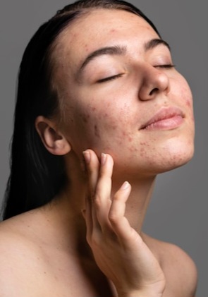 Acne Reduction Facial