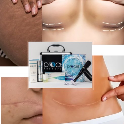 SCAR REMOVAL THERAPY at WilKay Wellness & Aesthetics in Gilbert, AZ