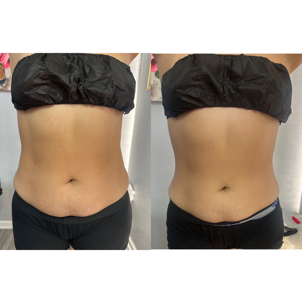 Waist Reduction at Goddess Beauty Studio in Elmwood Park, IL