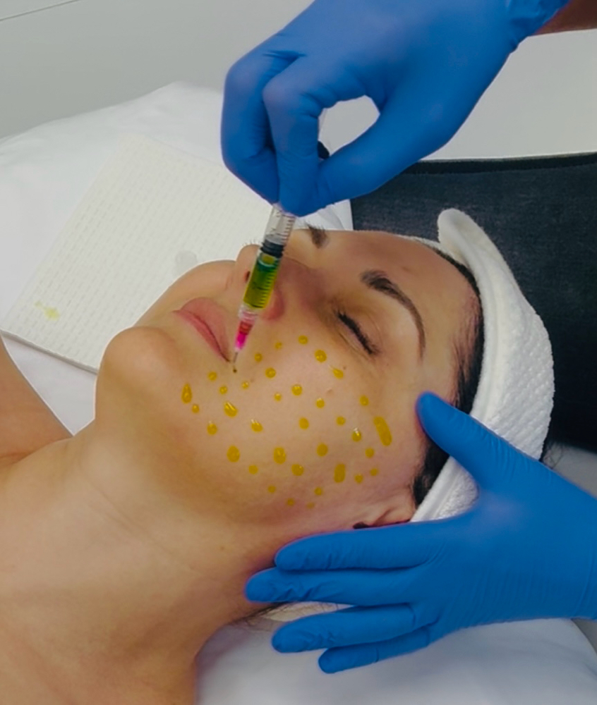 Microneedling+BioRePeel(Single) at Marina Novak in North Palm Beach, FL