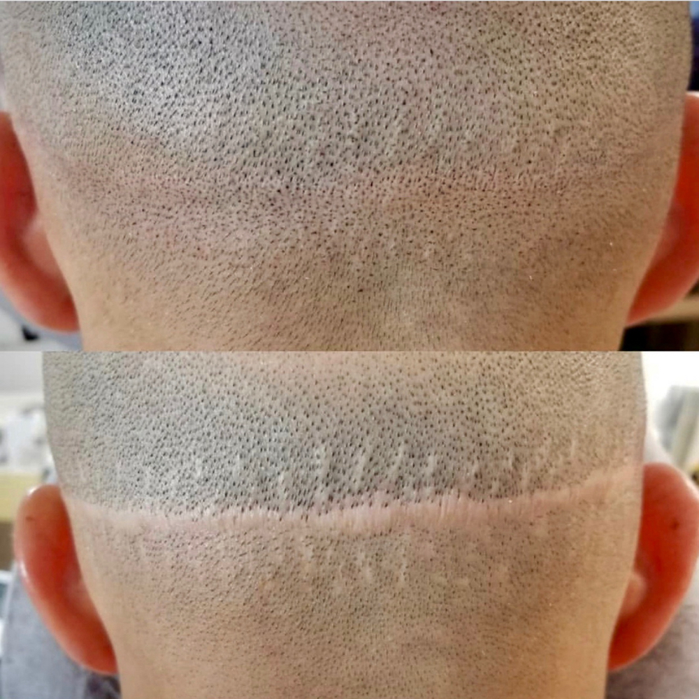 FUT Hair Transplant Scar Camouflage at Crown Aesthetx in Modesto, CA