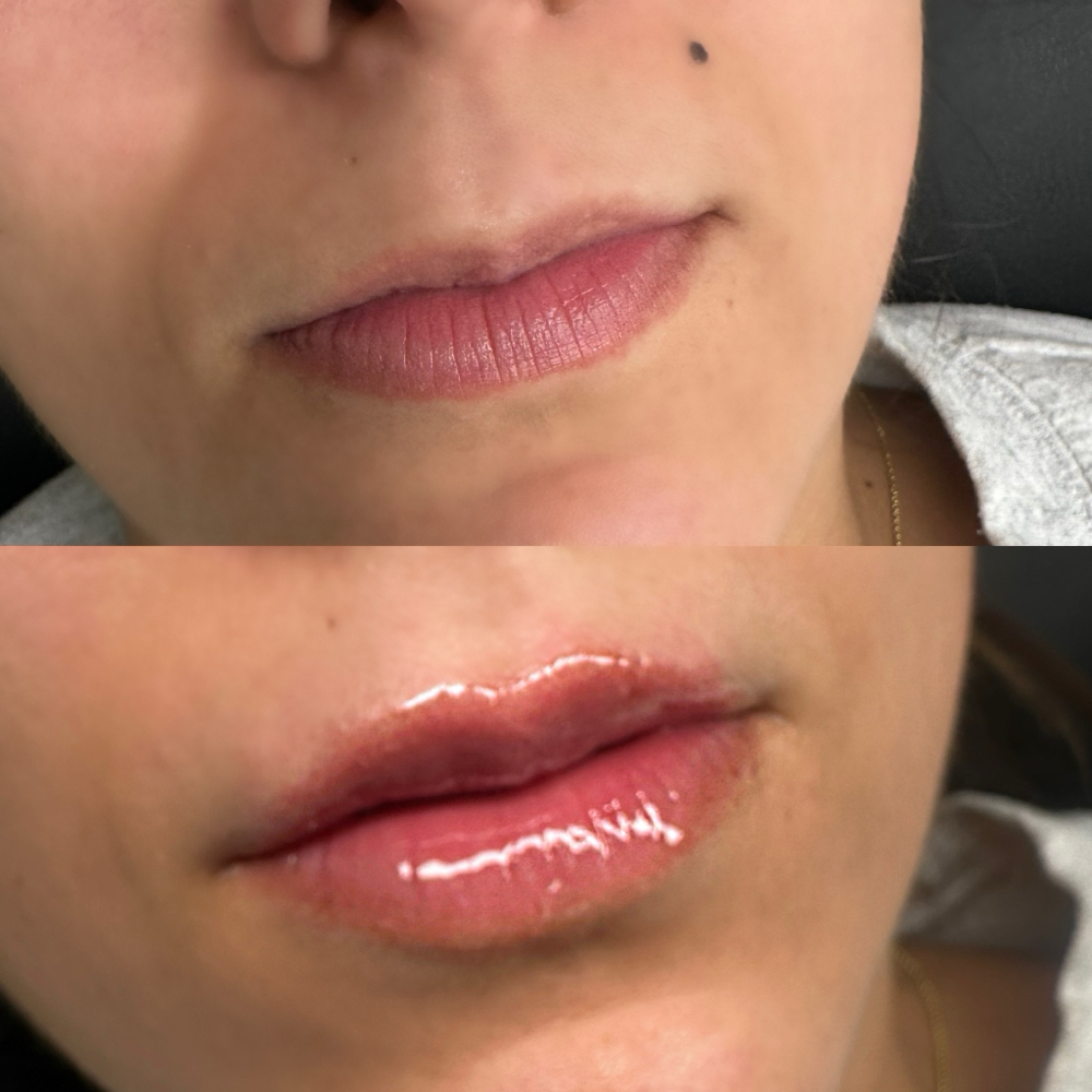 0.5 Needle-less Lip Filler