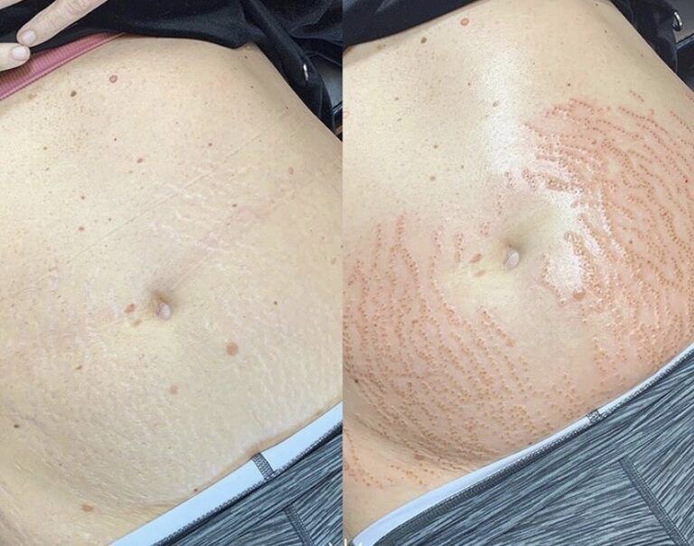 Inkless Stretch Mark Repair at STERLING INK & GLO in El Cajon, CA