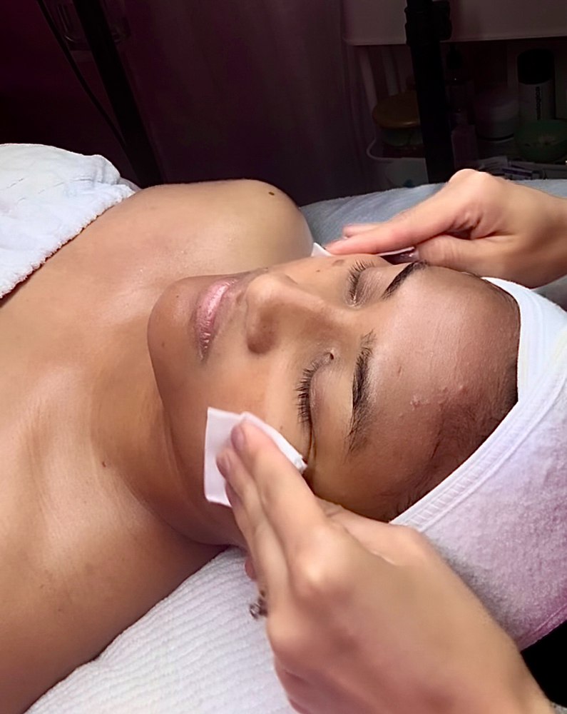Acne Clear Peel