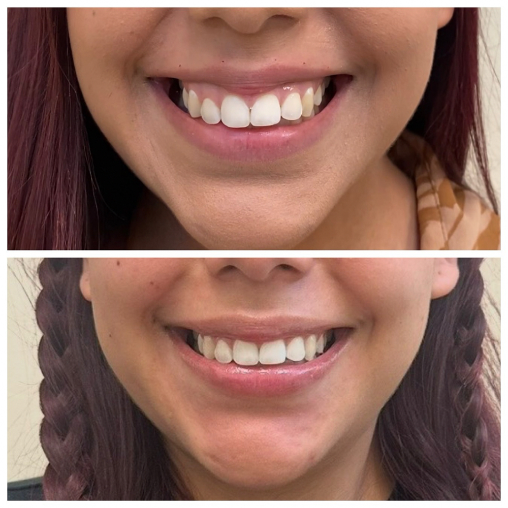 Gummy Smile at Morena Aesthetics & Wellness in Kyle, TX