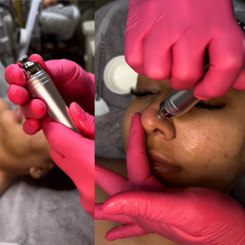 Microdermabrasion Face, Neck & Déco