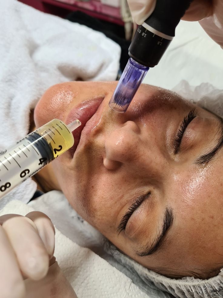Microneedling with Vitamin C