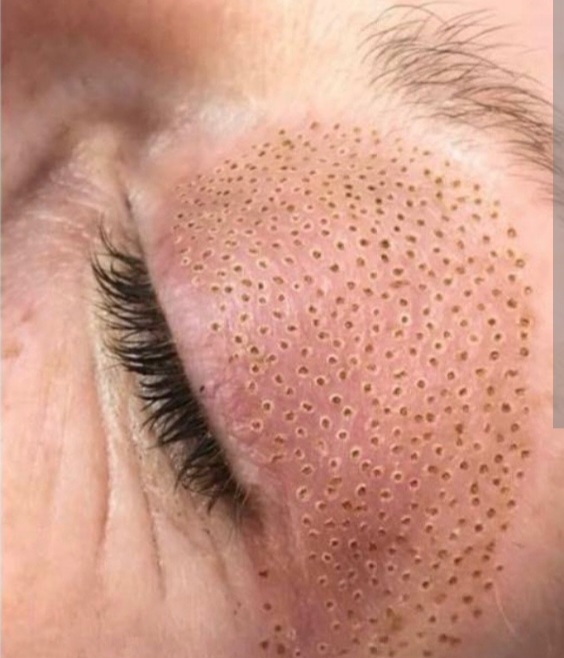 plasma - blepharoplasty