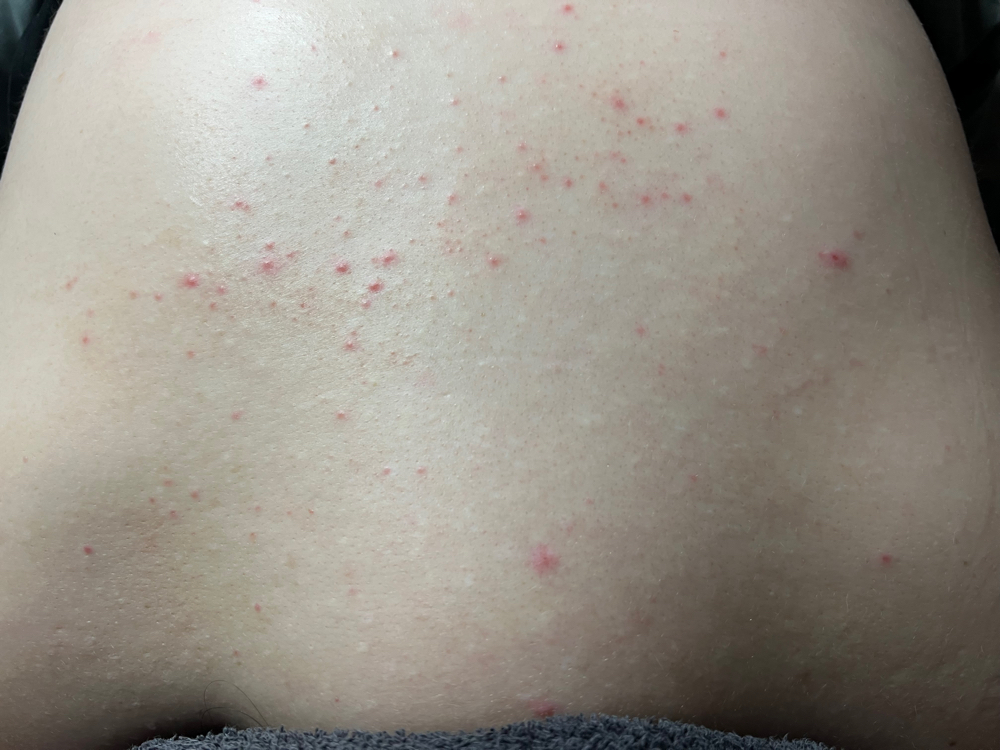 CLEAR SKIN BACK FACIAL at Bliss Skin by Sam LLC in Lafayette, IN