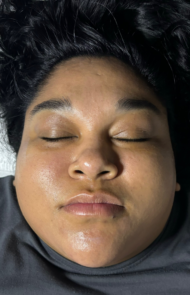Microdermabrasion Facial