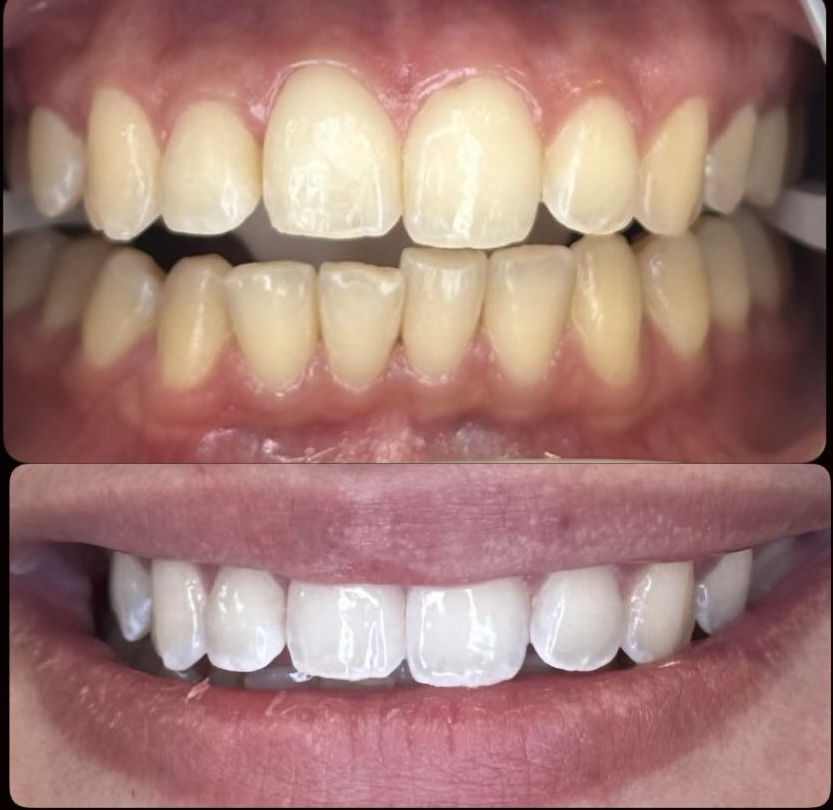 Sensitivity Teeth Whitening🦷✨