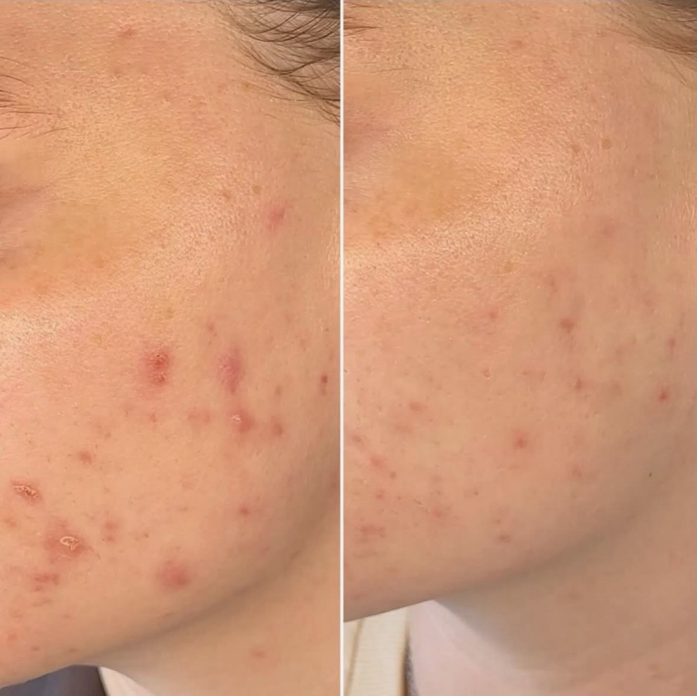1. Acne Boot Camp: The Reset at Sukoon Studio in Richardson, TX