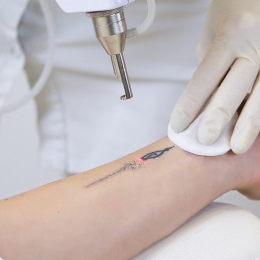 Body Tattoo Removal