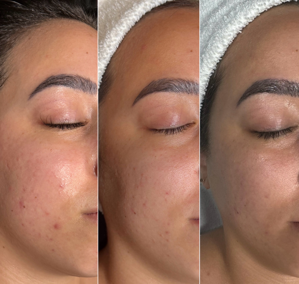 Nano Needling Facial