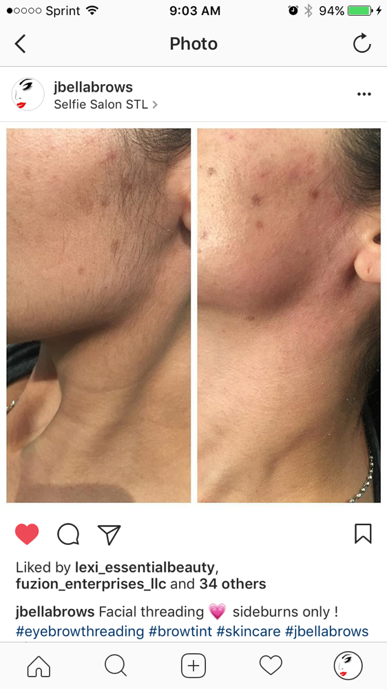 Dermaplanning