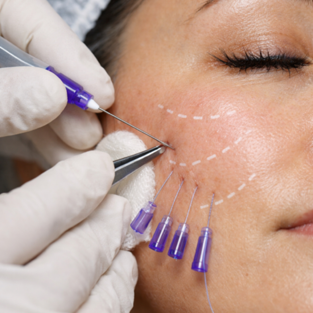 Pdo Threads/ Hilos Tensores Lateral at Beauty Couture MedSpa in Austin, TX