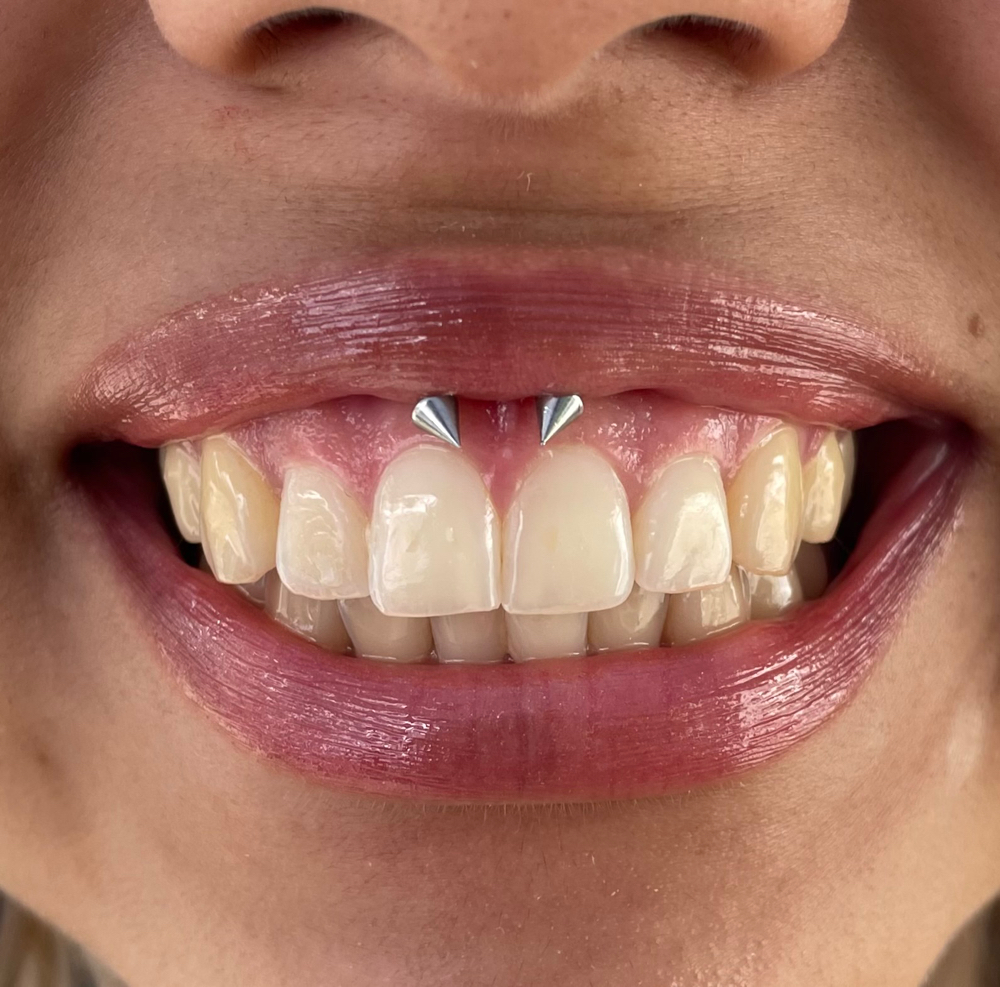 Smiley Piercing