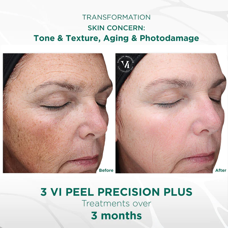 VI Peel 3 Package