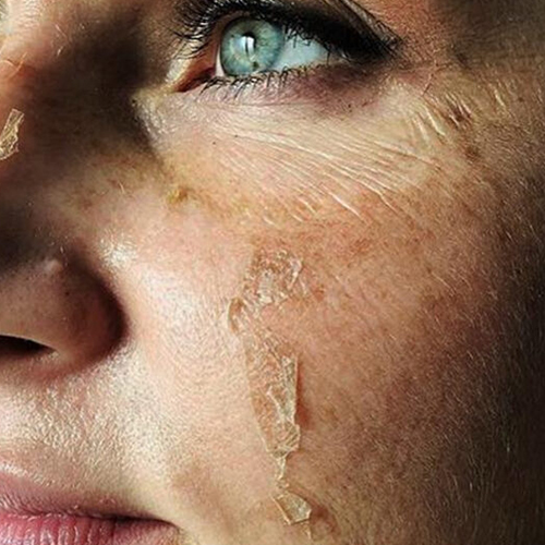 Chemical Peel