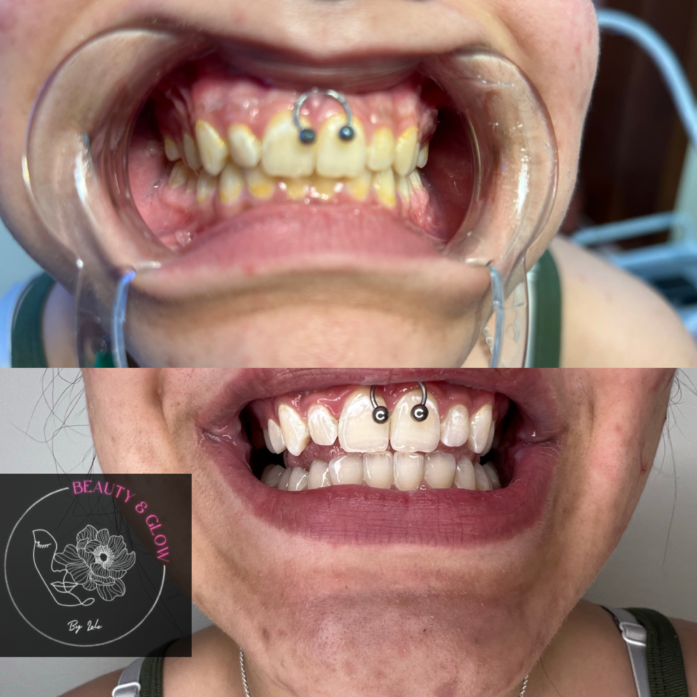 Tooth Whitening