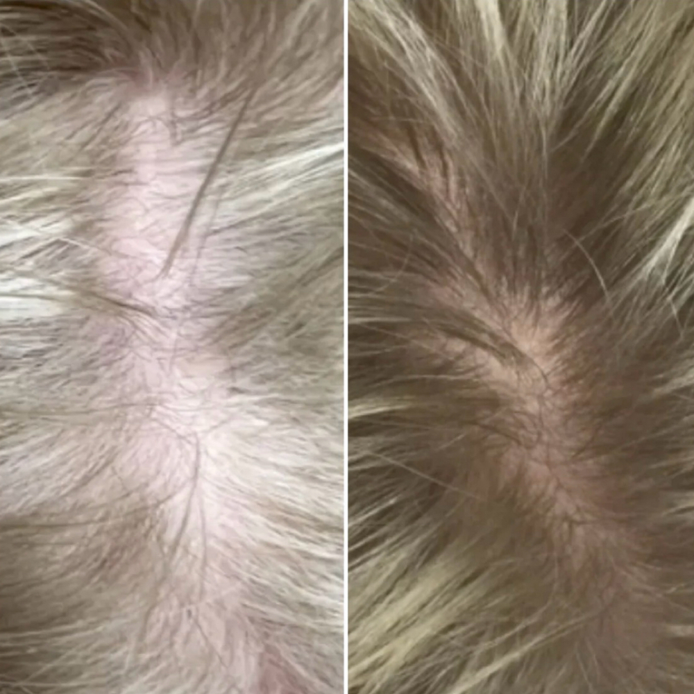 Hair Regrowth Spa (6 weeks Kit) at SALON LUME in Plano, TX