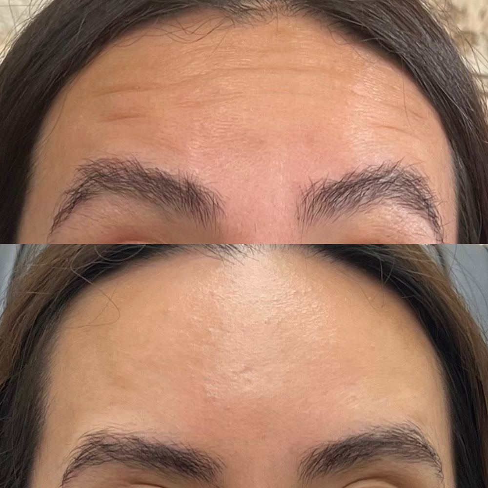 Botox - Frontalis (Forehead lines)