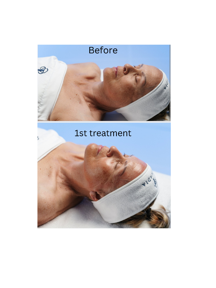 SWiCH Dermal Rejuvenation System