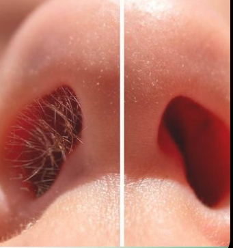 Nose Hair Removal Service