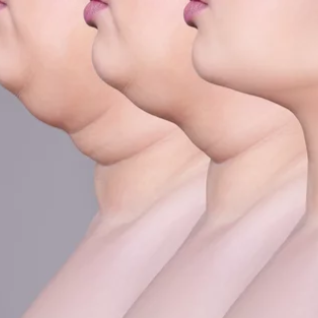 RF/Lipo Combo Double Chin Treatment at Skin Retribution in Roseville, CA