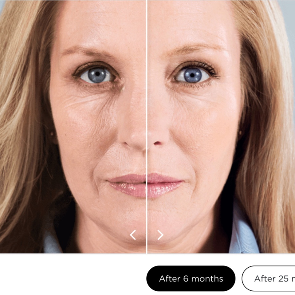 Sculptra at A. Shanel Aesthetics in Houston, TX