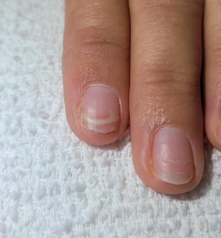 Nail Repair