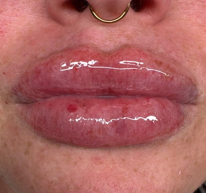 Needle-Free Lip Filler