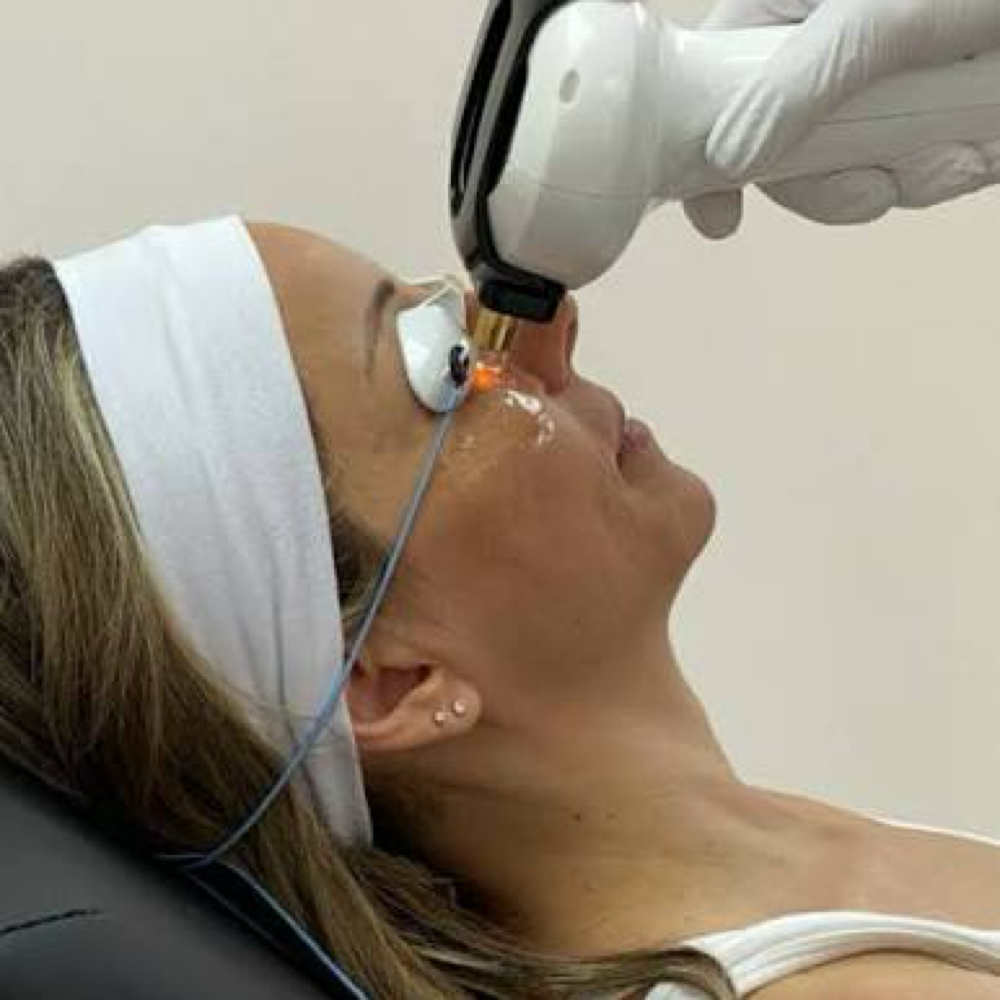 IPL Full Face at All Aesthetics Kare in Upland, CA