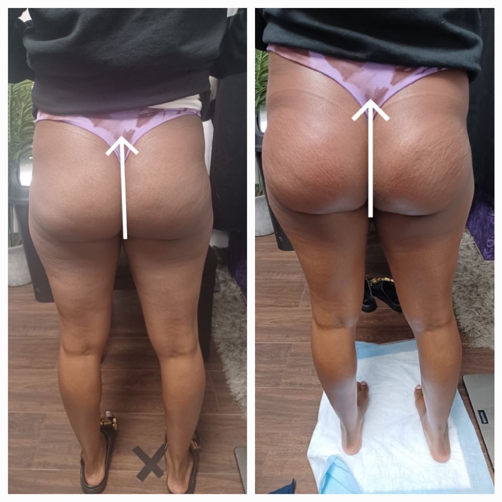 BUTT LIFT Single Treatment