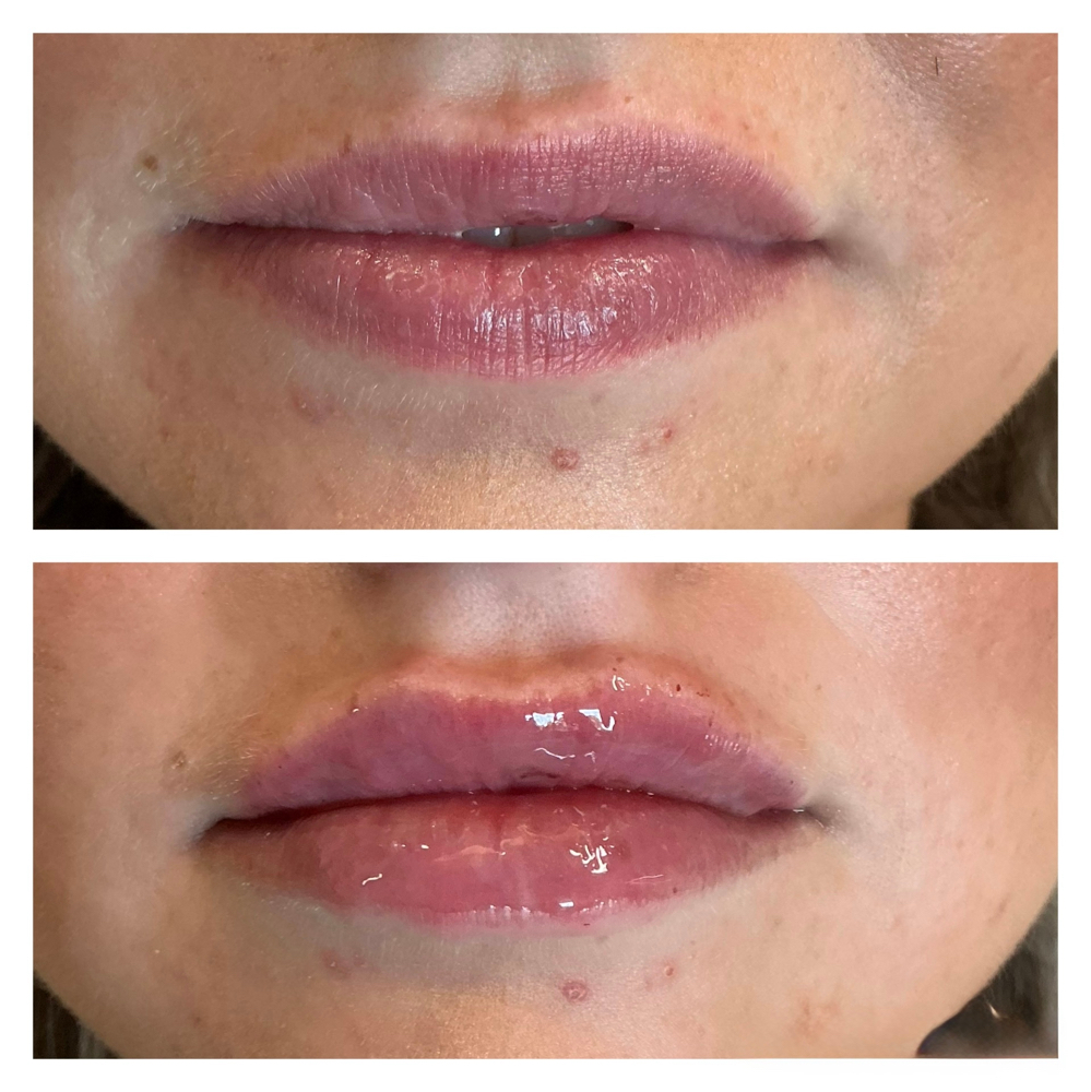 Lip Filler
