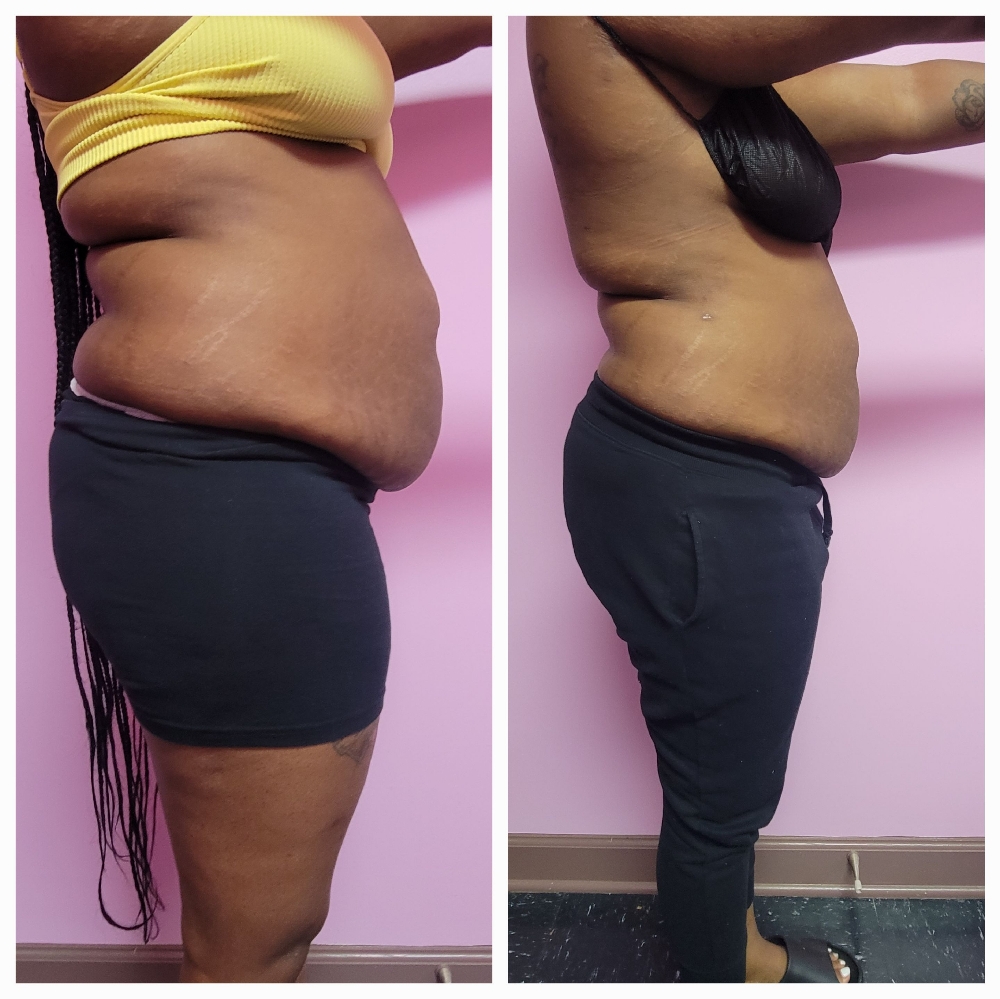 Mesotherapy