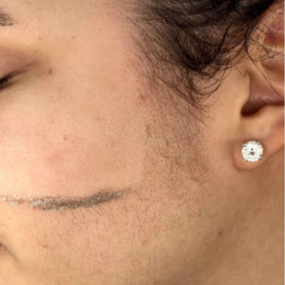Dermaplaning at Skin & Soul in Brooklyn, NY