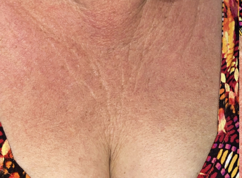 CHEST SKIN TIGHTENING