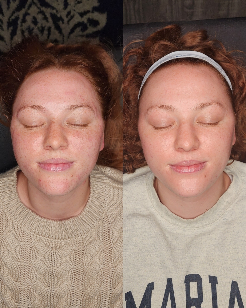 Sensitive Skin Reset + Consultation