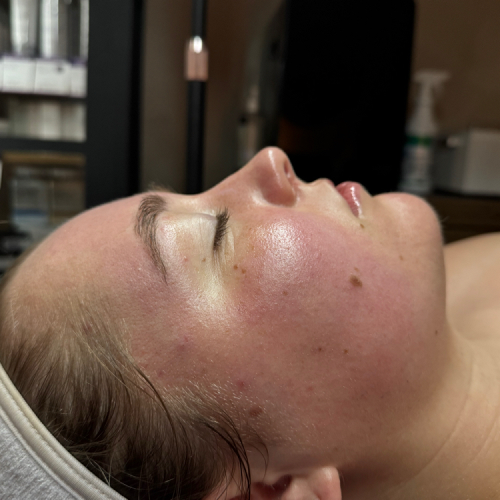 Acne Bootcamp at Satin Skin Esthetics in South Glens Falls, NY