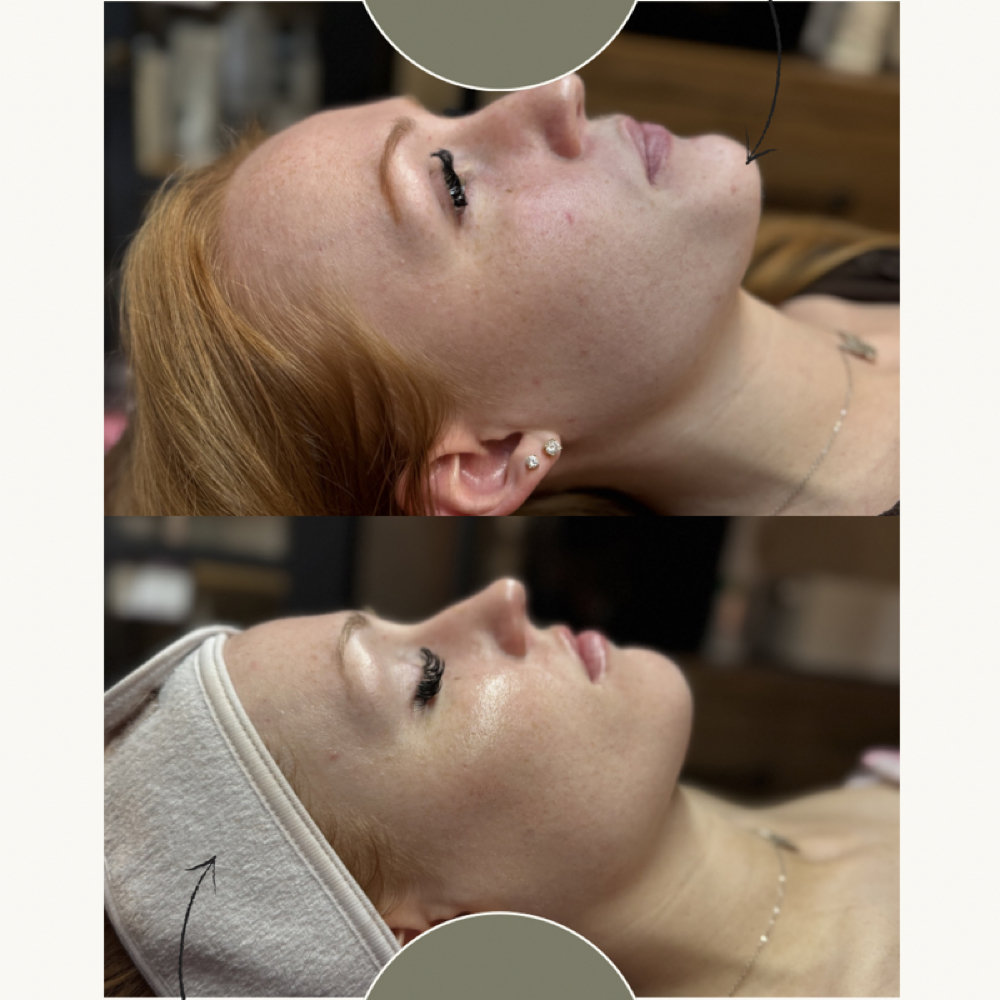 Acne Bootcamp at Satin Skin Esthetics LLC in Glens Falls, NY