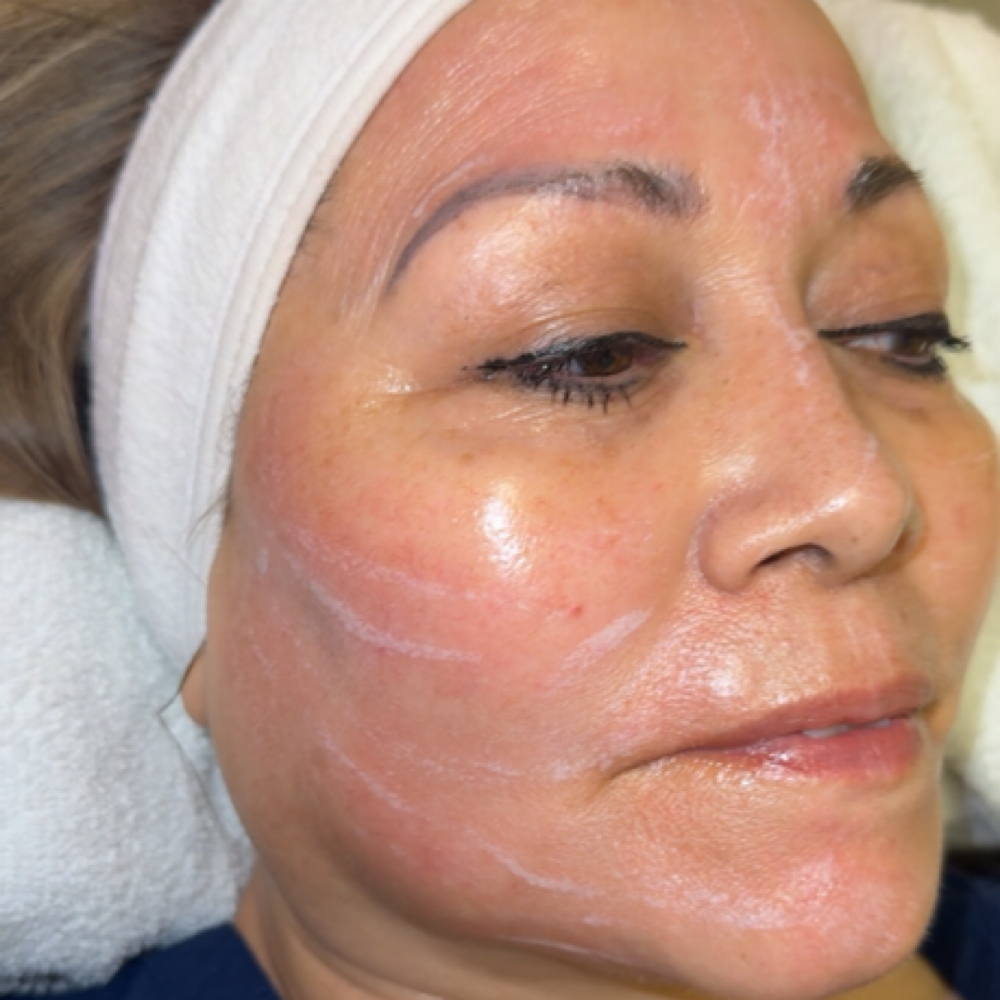 Chemical Peel at Blissful Brows & Lashes in Thornton, CO
